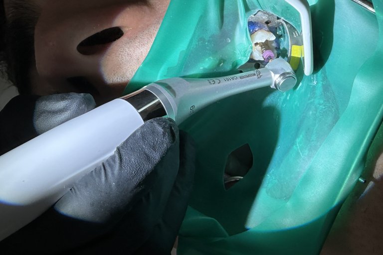 Tratament de canal la microscop în Bacău – precizie premium pentru salvarea dintelui natural
