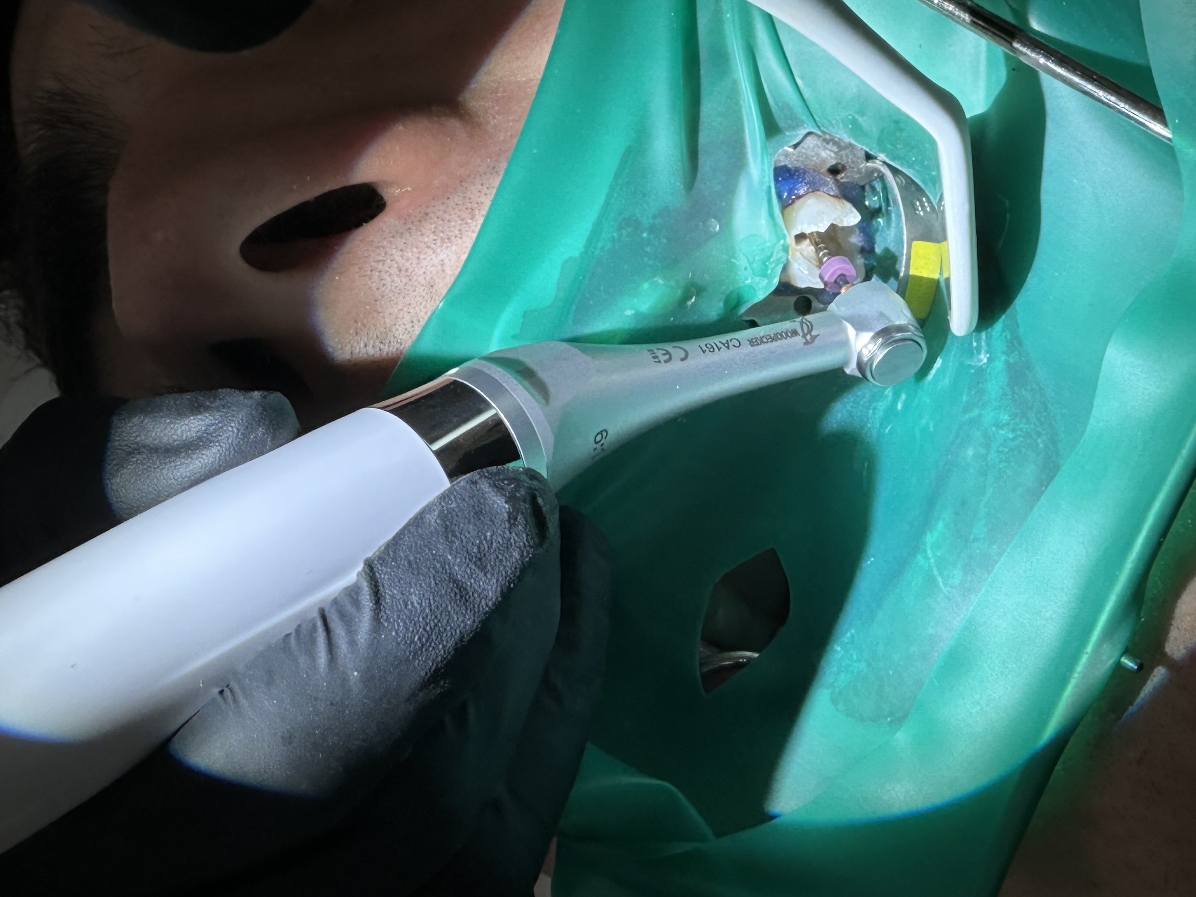 Rezultate tratament de canal la microscop - Dent 4 All Clinic Bacău
